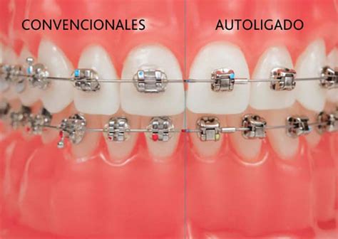 diferencia entre brackets metalicos y autoligados|diferencia entre bracketes y autoligados.